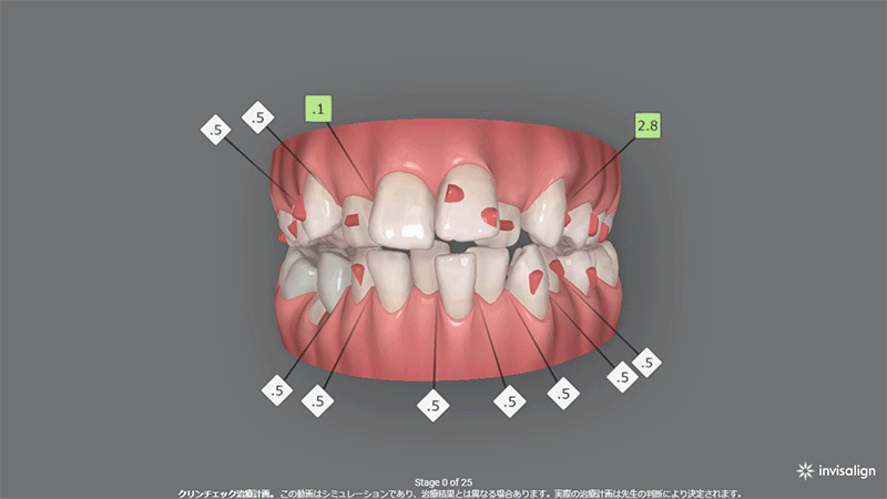 上顎2本抜歯症例 (20代女性)叢生(凸凹)の改善　