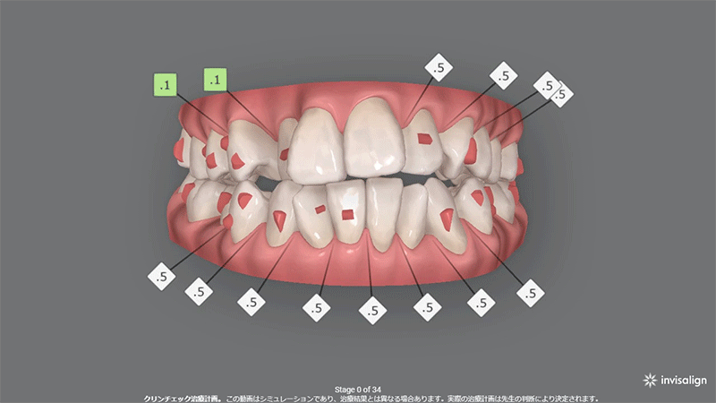上顎2本抜歯症例 (30代女性) 真ん中のずれの改善 叢生(凸凹)の改善