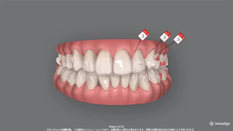 上顎2本抜歯症例 (30代女性) 真ん中のずれの改善 叢生(凸凹)の改善
