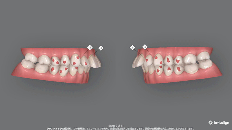 非抜歯 前歯の突出感 (30代女性)
